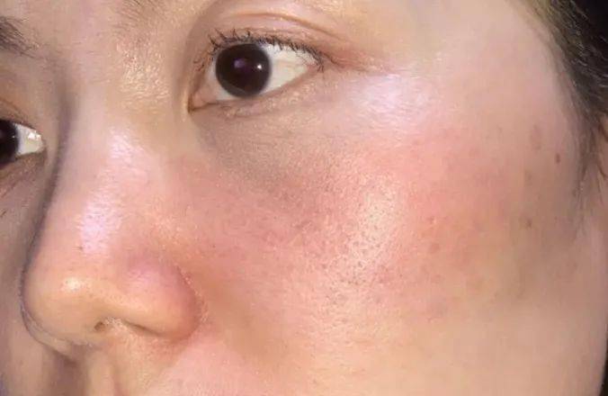 屏障受損干敏皮自救指南