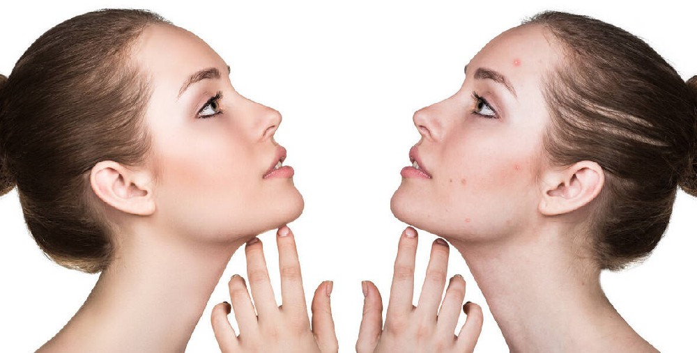 痘痘、閉口、粉刺大區分！教你精準對癥解決